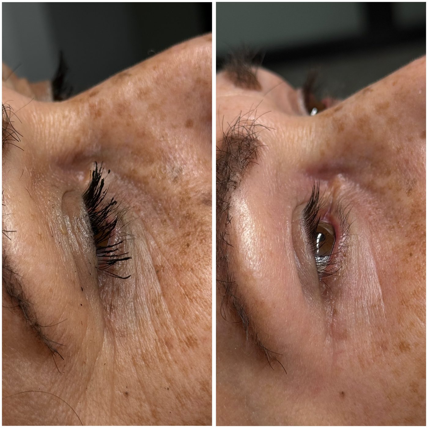 Blefaroplastia no quirúrgica
