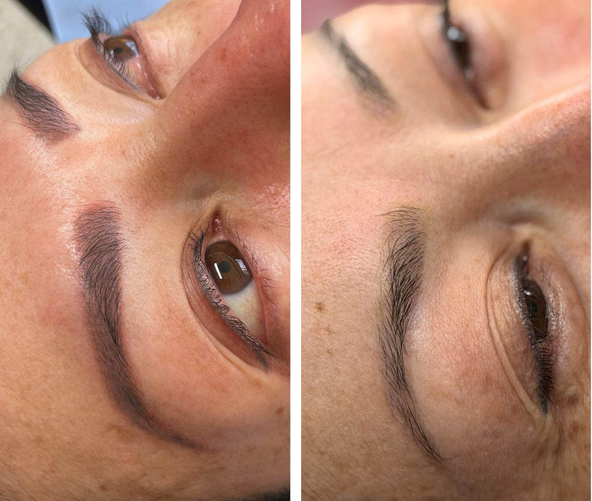 Remoción láser cejas