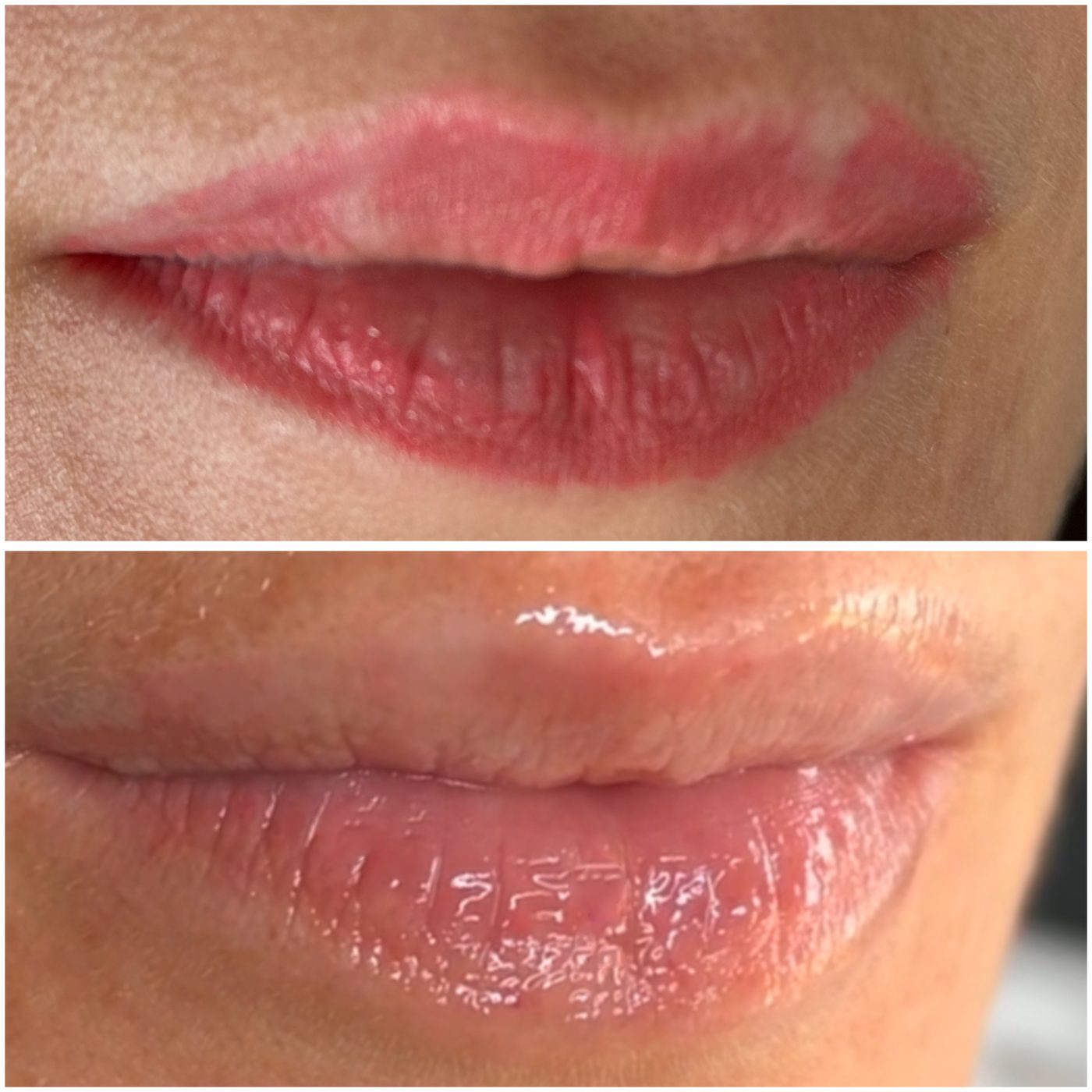 Remoción láser labios y párpados