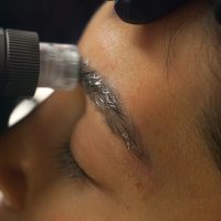 Rehabilitación folicular de cejas