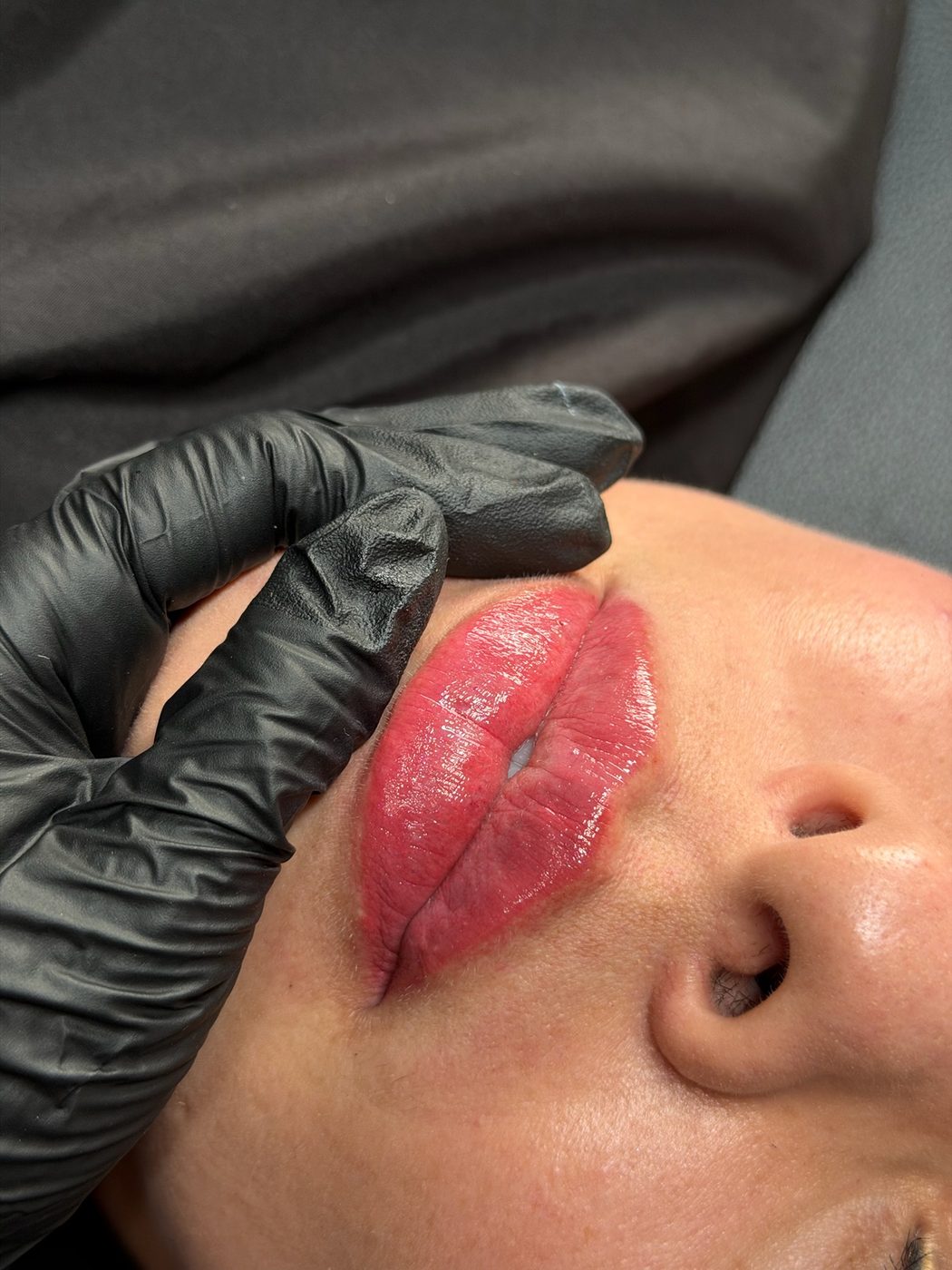 Aumento de labios