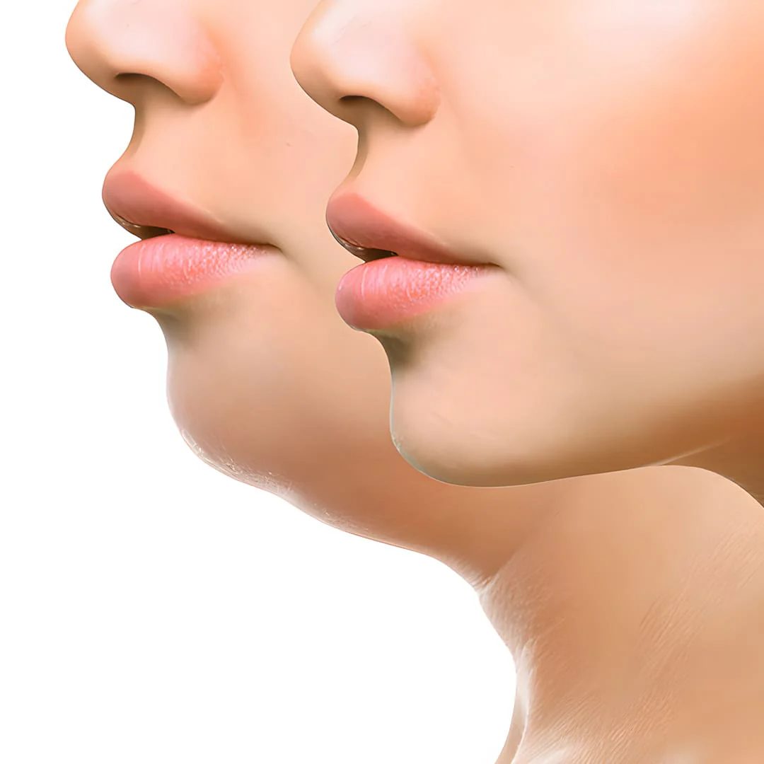 Lipopapada y perfilamiento enzimático